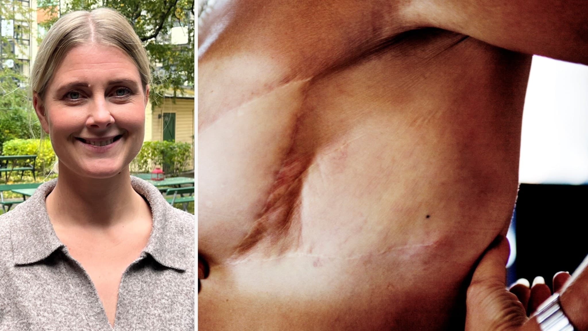 Bildmontage visar Frida Uddemar ståendes utomhus och en närbild av ett bröst med ett stort operationsärr på sidan efter bröstcancer. 