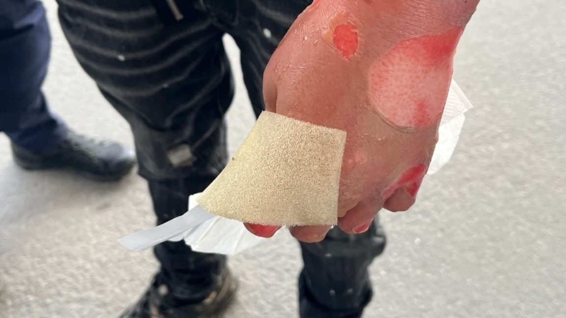En brännskadad hand med rodnader, blåsor och spår av vätska. Personen står utomhus på asfalt och bär mörka byxor. 